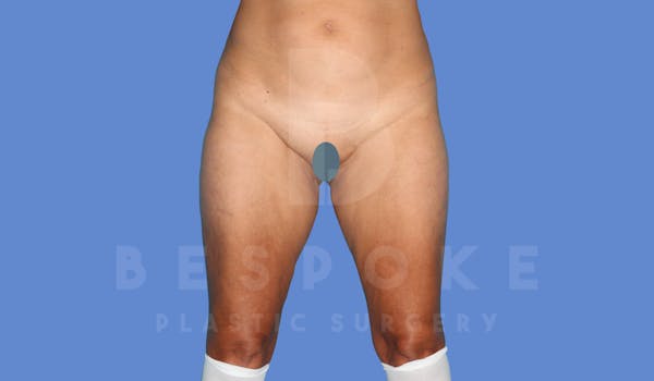 Liposuction Before & After Gallery - Patient 143826854 - Image 1
