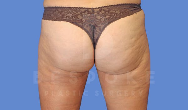 Liposuction Before & After Gallery - Patient 143826854 - Image 4