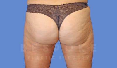 Liposuction Before & After Gallery - Patient 143826854 - Image 4