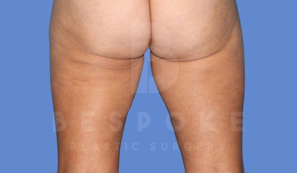 Liposuction Before & After Gallery - Patient 143826854 - Image 3