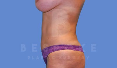 Liposuction Before & After Gallery - Patient 143826853 - Image 4