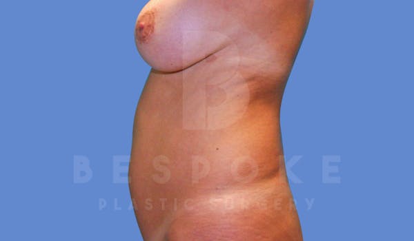Liposuction Before & After Gallery - Patient 143826853 - Image 3
