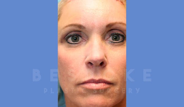 Facial Fat Grafting Before & After Gallery - Patient 143826861 - Image 2