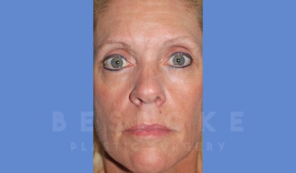 Facial Fat Grafting Before & After Gallery - Patient 143826861 - Image 1