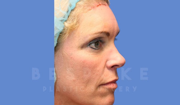 Facial Fat Grafting Before & After Gallery - Patient 143826861 - Image 4