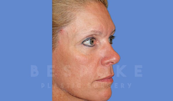 Facial Fat Grafting Before & After Gallery - Patient 143826861 - Image 3
