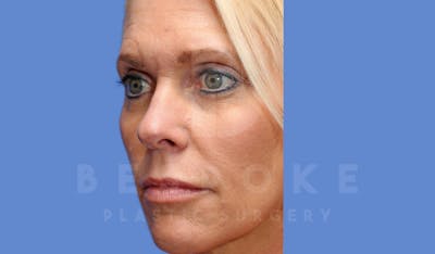 Facial Fat Grafting Before & After Gallery - Patient 143826861 - Image 6