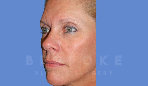 Facial Fat Grafting Before & After Gallery - Patient 143826861 - Image 5