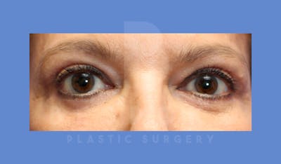 Eyelid Surgery Before & After Gallery - Patient 143826868 - Image 2