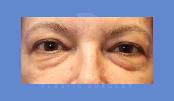 Eyelid Surgery Before & After Gallery - Patient 143826868 - Image 1