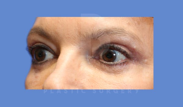 Eyelid Surgery Before & After Gallery - Patient 143826868 - Image 4