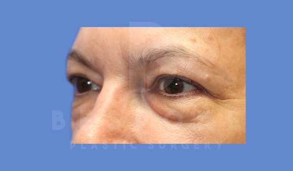 Eyelid Surgery Before & After Gallery - Patient 143826868 - Image 3
