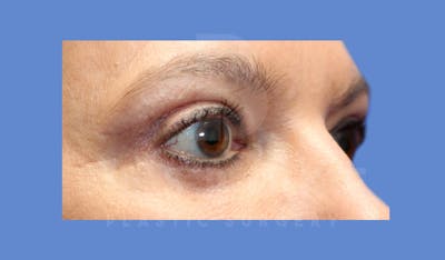 Eyelid Surgery Before & After Gallery - Patient 143826868 - Image 6