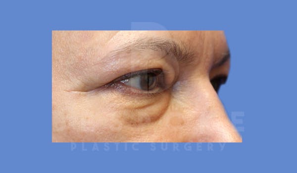Eyelid Surgery Before & After Gallery - Patient 143826868 - Image 5
