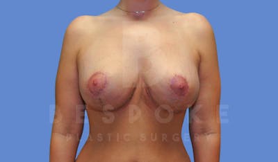 Breast Revision Surgery Before & After Gallery - Patient 143826886 - Image 2
