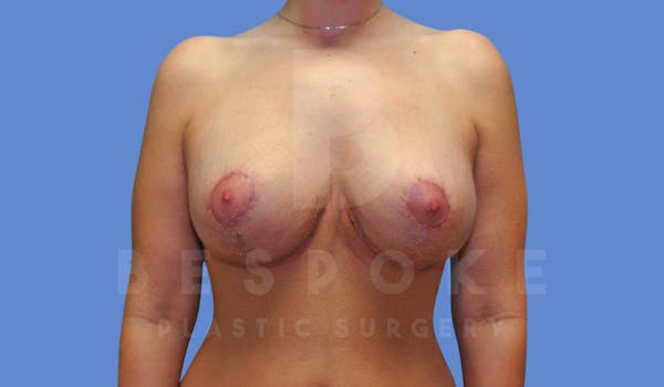 Breast Revision Surgery Before & After Gallery - Patient 143826886 - Image 2