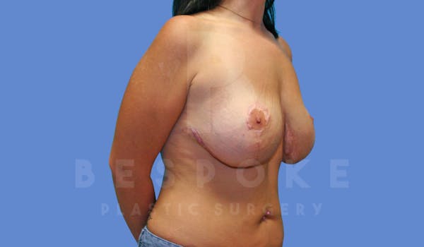 Breast Revision Surgery Before & After Gallery - Patient 143826886 - Image 3