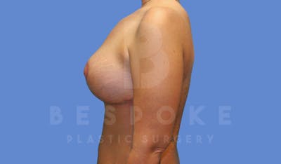 Breast Revision Surgery Before & After Gallery - Patient 143826886 - Image 6