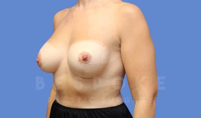 Breast Revision Surgery Before & After Gallery - Patient 143826885 - Image 4