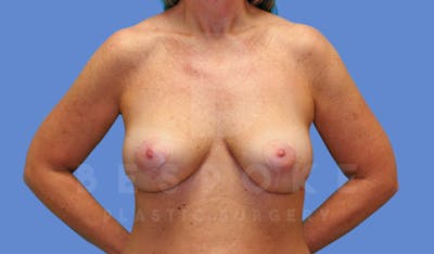 Breast Lift With Implants Before & After Gallery - Patient 143826945 - Image 2