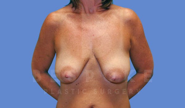 Breast Lift With Implants Before & After Gallery - Patient 143826945 - Image 1