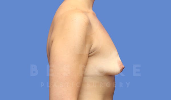 Breast Lift With Implants Before & After Gallery - Patient 143826946 - Image 5