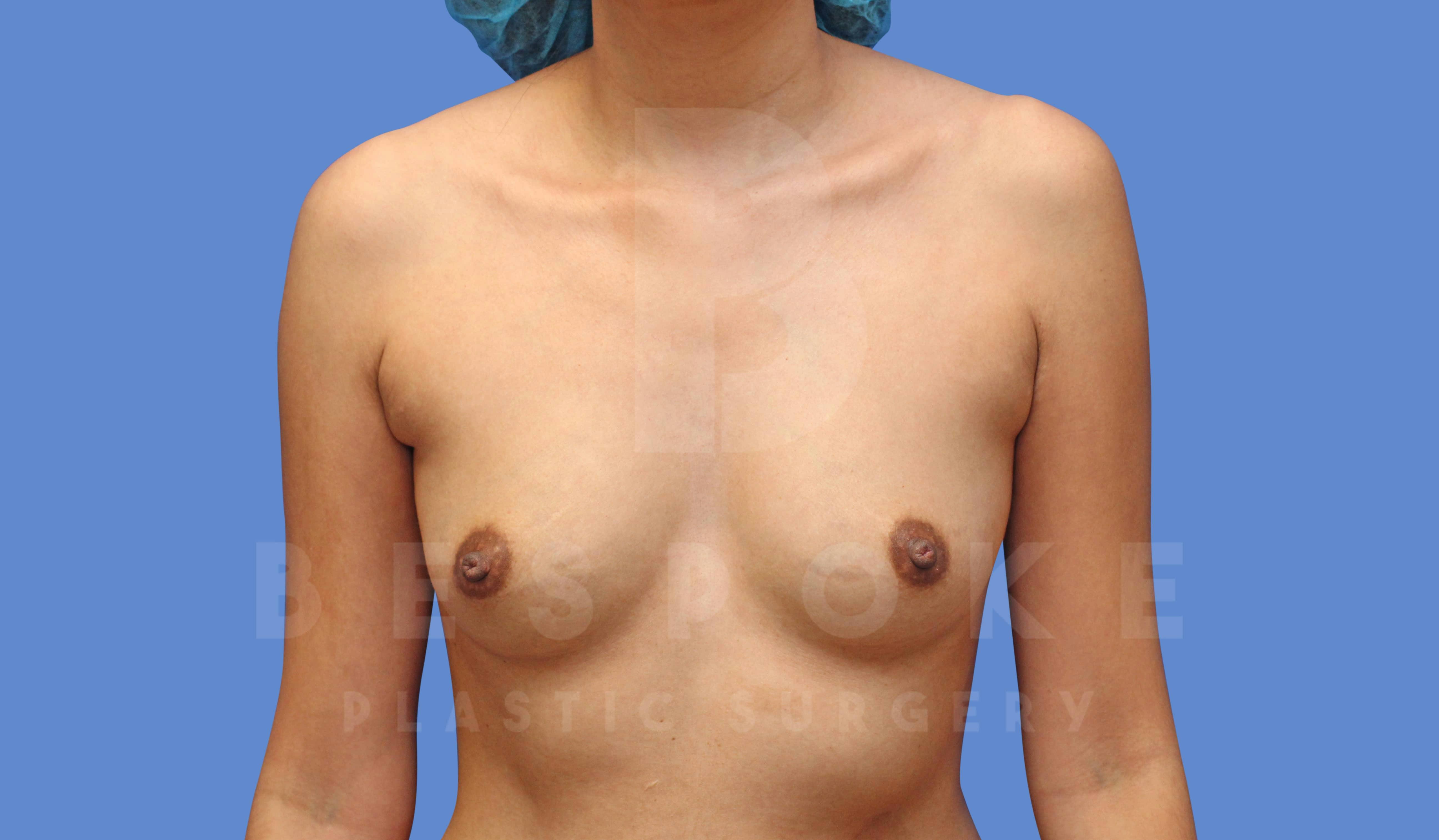 Breast Augmentation Before & After Gallery - Patient 143827137 - Image 1