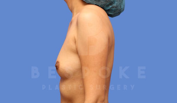 Breast Augmentation Before & After Gallery - Patient 143827137 - Image 3