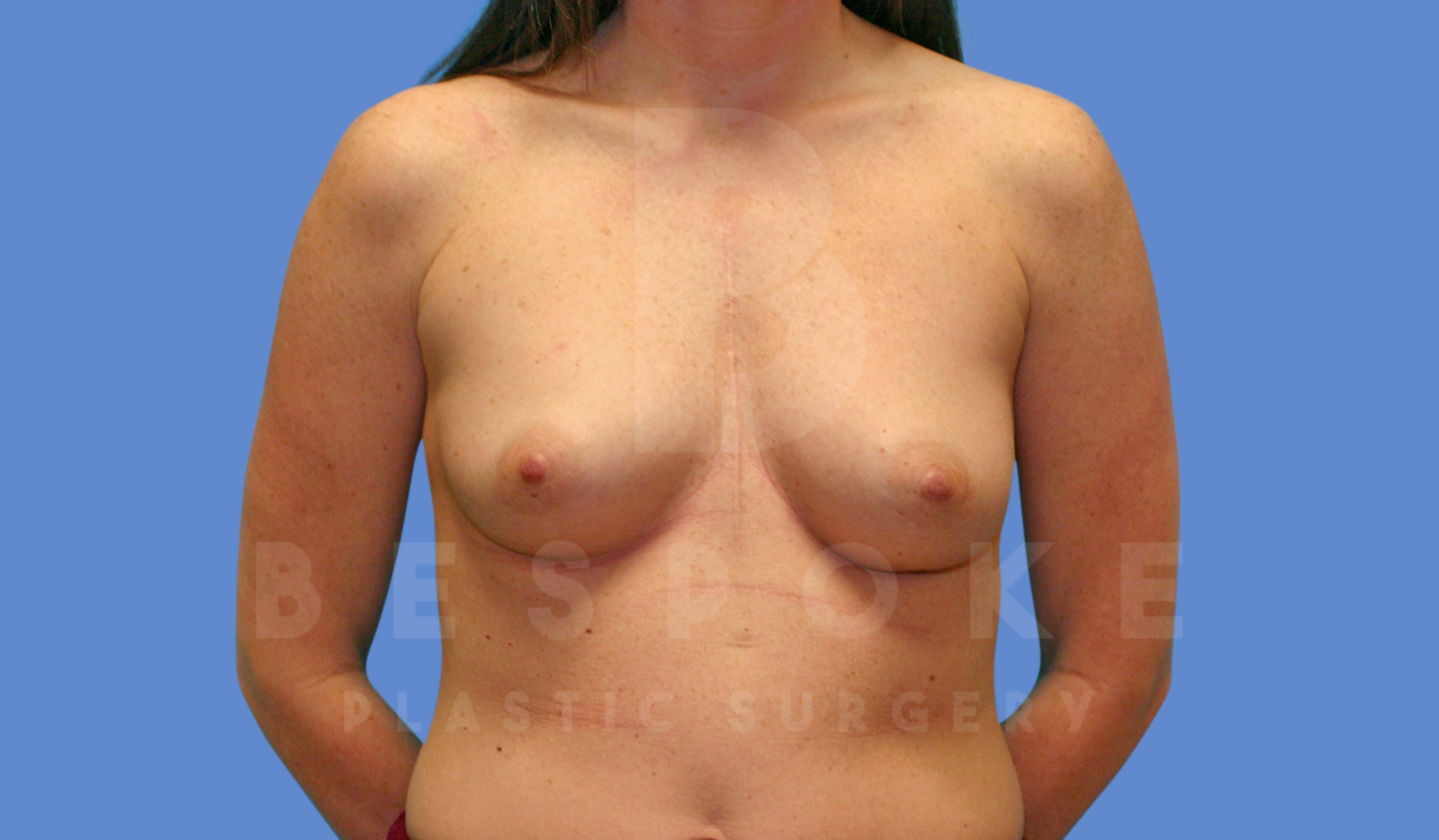 Breast Augmentation Before & After Gallery - Patient 143827136 - Image 1