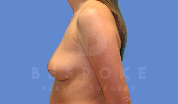Breast Augmentation Before & After Gallery - Patient 143827136 - Image 5