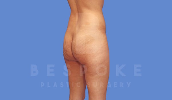 Brazilian Butt Lift Before & After Gallery - Patient 143827860 - Image 1