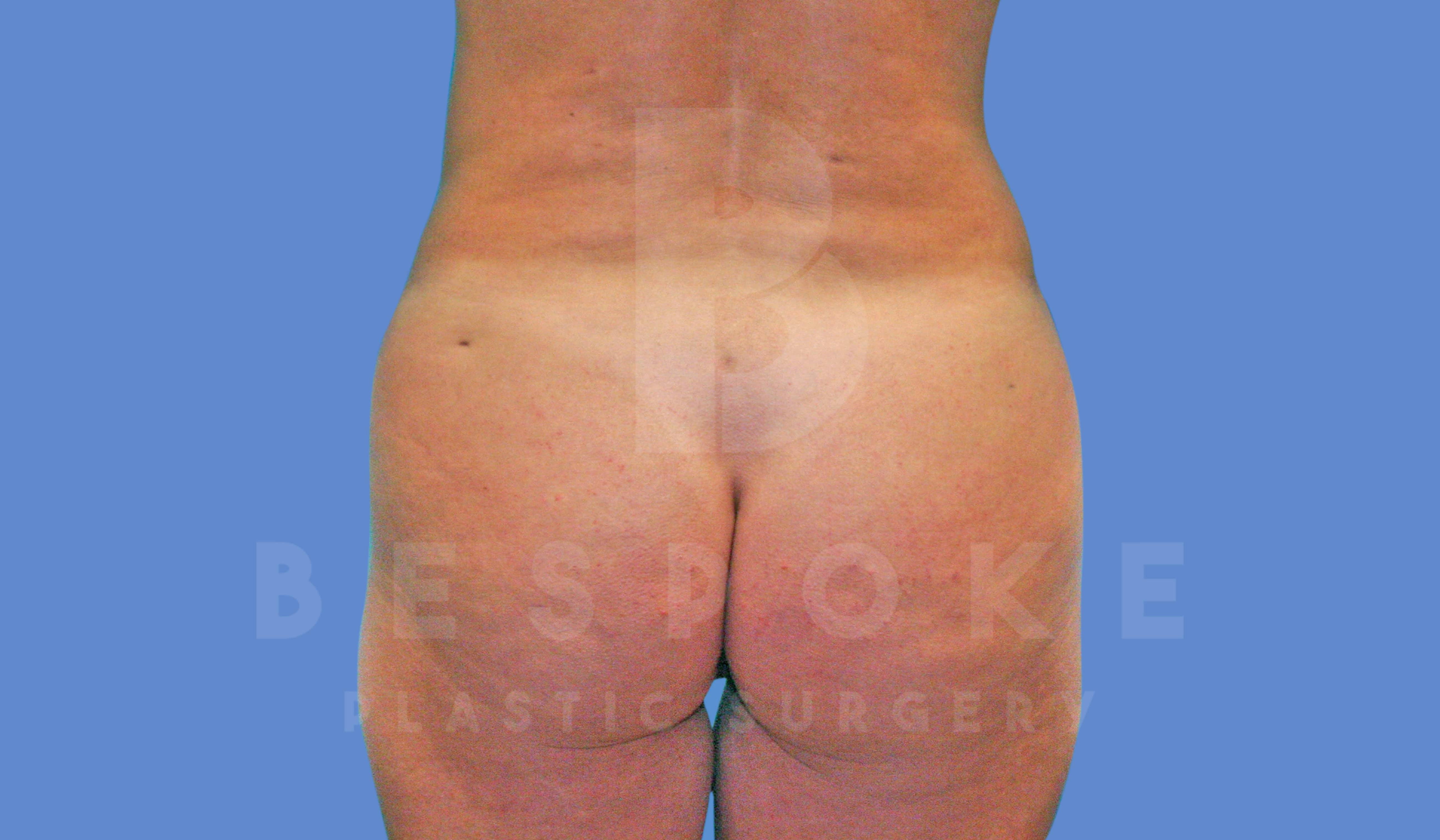 Brazilian Butt Lift Before & After Gallery - Patient 143827858 - Image 2