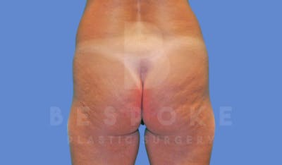 Brazilian Butt Lift Before & After Gallery - Patient 143827858 - Image 1