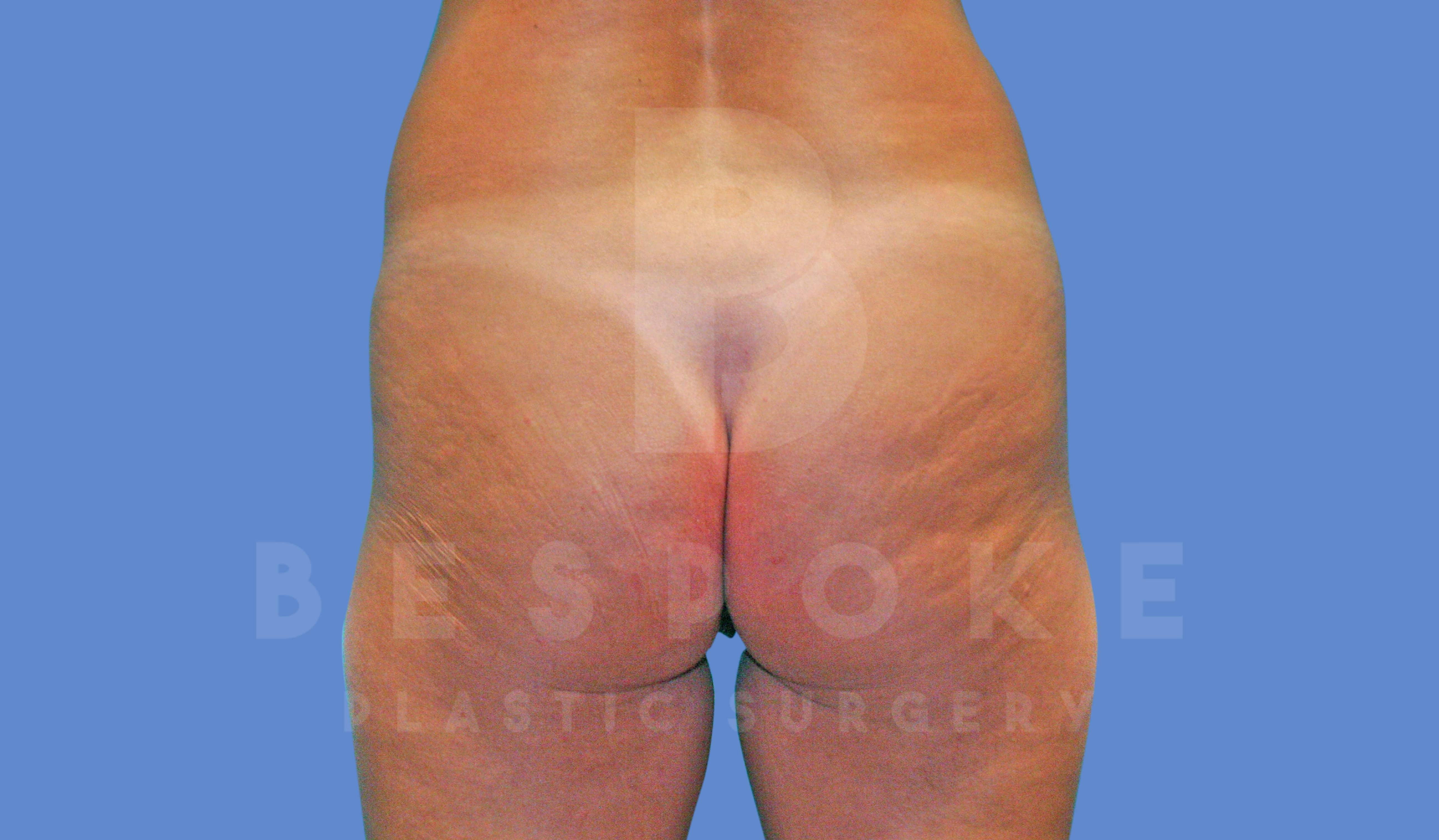 Brazilian Butt Lift Before & After Gallery - Patient 143827858 - Image 1