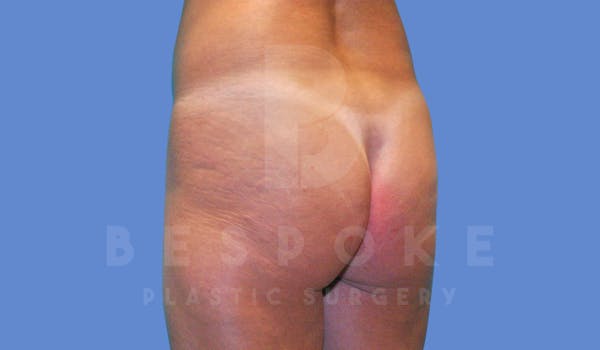 Brazilian Butt Lift Before & After Gallery - Patient 143827858 - Image 3