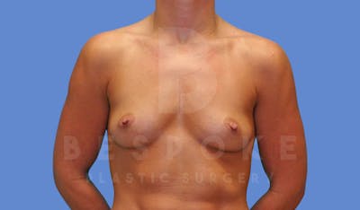 Breast Augmentation Before & After Gallery - Patient 144119425 - Image 1