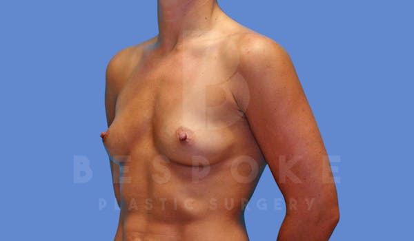 Breast Augmentation Before & After Gallery - Patient 144119425 - Image 3