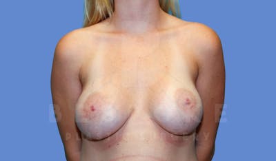 Breast Augmentation Before & After Gallery - Patient 144119424 - Image 2