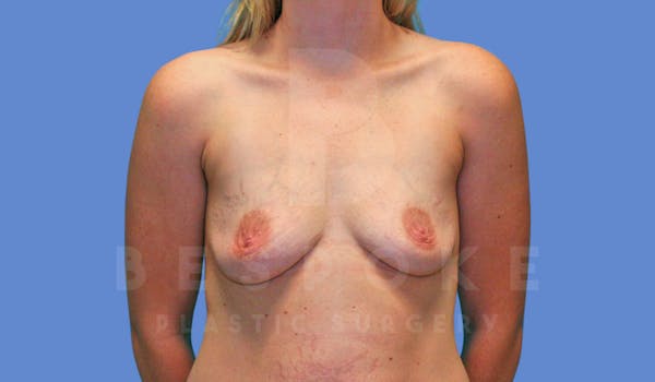Breast Augmentation Before & After Gallery - Patient 144119424 - Image 1