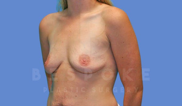 Breast Augmentation Before & After Gallery - Patient 144119424 - Image 3