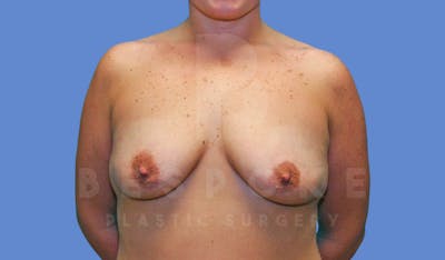 Breast Augmentation Before & After Gallery - Patient 144119423 - Image 1