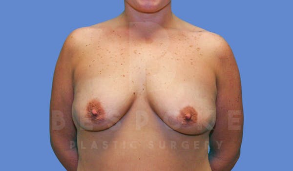 Breast Augmentation Before & After Gallery - Patient 144119423 - Image 1