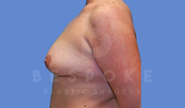 Breast Augmentation Before & After Gallery - Patient 144119423 - Image 3