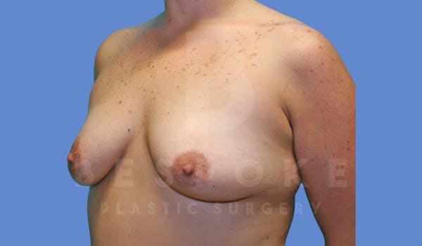 Breast Augmentation Before & After Gallery - Patient 144119423 - Image 5