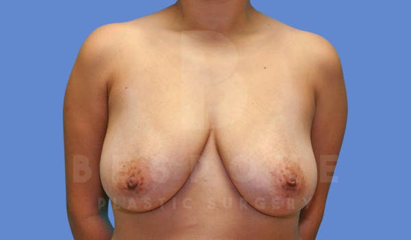 Breast Lift With Implants Before & After Gallery - Patient 144120092 - Image 1