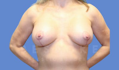 Breast Lift With Implants Before & After Gallery - Patient 144120091 - Image 2