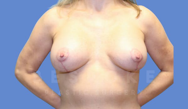 Breast Lift With Implants Before & After Gallery - Patient 144120091 - Image 2