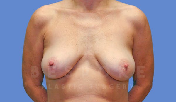 Breast Lift With Implants Before & After Gallery - Patient 144120091 - Image 1