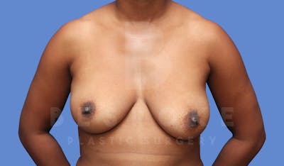 Breast Lift With Implants Before & After Gallery - Patient 144120450 - Image 1