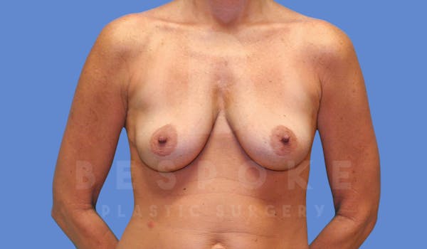 Breast Lift With Implants Before & After Gallery - Patient 144120449 - Image 1